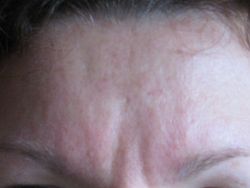 Tiêm tổng cộng 52 unit botox vào nếp cau mày nhưng có vẻ không tác dụng?