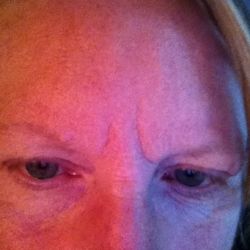 Nếp nhăn giữa hai bên lông mày không khác gì sau 2 lần tiêm botox?