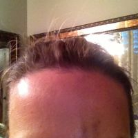 Bầm tím và sưng sau tiêm botox xóa nếp cau mày: liệu có phải là do tụ máu không?