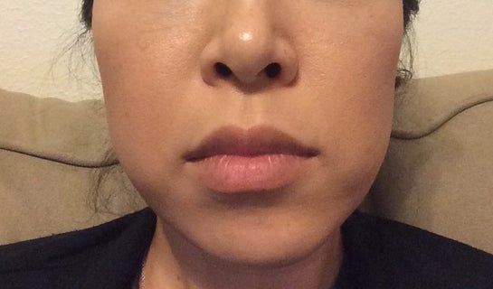 Tiêm botox góc hàm liệu có giúp cải thiện tình trạng bất cân đối trên khuôn mặt của tôi không?