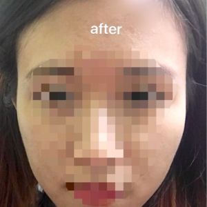 Hóp thái dương sau tiêm botox góc hàm