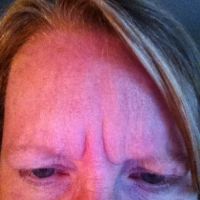 Nếp nhăn giữa hai bên lông mày không khác gì sau 2 lần tiêm botox?