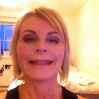 Nụ cười của tôi đã hoàn toàn thay đổi sau khi tiêm botox vào trán, nếp cau mày, nếp chân chim và dưới mắt???
