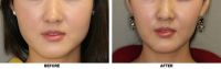 Tôi có nên tiêm Botox góc hàm để thu giảm cơ cắn không và quy trình này thường có giá bao nhiêu?