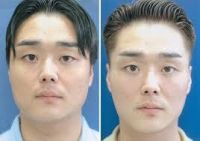 Tôi có nên tiêm Botox góc hàm để thu giảm cơ cắn không và quy trình này thường có giá bao nhiêu?