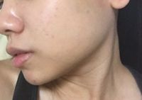 Da tôi bị chảy xệ sau khi tiêm bottox vào cơ cắn vùng hàm: phải làm gì bây giờ?