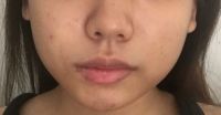Da tôi bị chảy xệ sau khi tiêm bottox vào cơ cắn vùng hàm: phải làm gì bây giờ?
