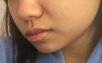 Da tôi bị chảy xệ sau khi tiêm bottox vào cơ cắn vùng hàm: phải làm gì bây giờ?