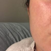 Cơ cắn phình to hơn sau khi tiêm botox gọn hàm: điều này có bình thường không?