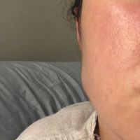 Cơ cắn phình to hơn sau khi tiêm botox gọn hàm: điều này có bình thường không?