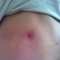 Cục cứng dưới da ở vị trí ngay bên dưới xương sườn, 2 năm sau tạo hình thành bụng?