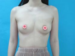 Có phải tôi bị lồi đáy vú?