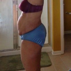 Tôi có cần hút mỡ thể tích lớn hay không?