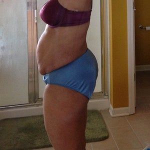 Tôi có cần hút mỡ thể tích lớn hay không?