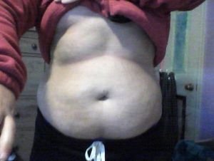 Hút mỡ có thể giúp cháu có đường cong ở bụng không?