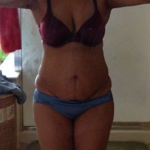 Tôi có cần hút mỡ thể tích lớn hay không?