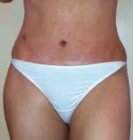 Đau nhói, bỏng rát ở bùng mu kèm nổi cục sau tạo hình thành bụng và hút mỡ, khi nào mới hết?