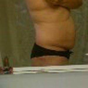 Cao 1m57, nặng 79 kg: Có nên hút mỡ ở bụng, lưng và hông?