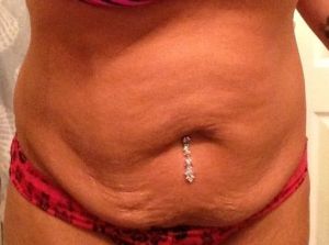 Đã giảm được 36 kg, chăm chỉ tập luyện, tôi có nên hút mỡ không?