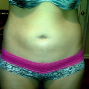 Hút mỡ chỉnh sửa có làm bụng tôi đẹp hơn?