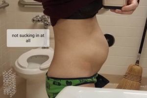 Hút mỡ ThermaLipo có chữa được tách cơ bụng cho bệnh nhân gầy không?