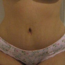 Tại sao da bụng tôi mềm nhưng lại thấy đau sau tạo hình thành bụng?