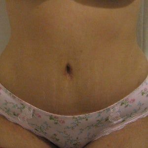 Tại sao da bụng tôi mềm nhưng lại thấy đau sau tạo hình thành bụng?