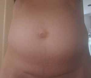 Hút mỡ ThermaLipo có chữa được tách cơ bụng cho bệnh nhân gầy không?