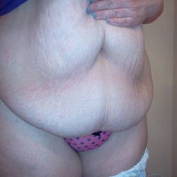 Đau, sưng nề, co rút cơ bụng sau 2 tuần từ khi làm tạo hình thành bụng. Có bình thường không?