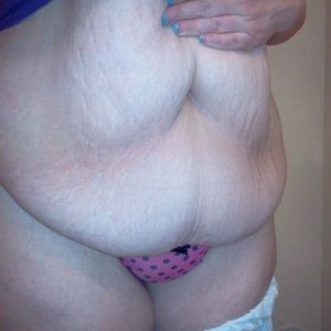 Đau, sưng nề, co rút cơ bụng sau 2 tuần từ khi làm tạo hình thành bụng. Có bình thường không?