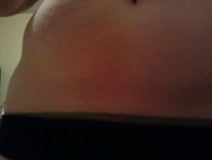 Tôi thấy da mình không bị chảy xệ, tôi có hợp làm hút mỡ (bụng, lườn, lưng) không?