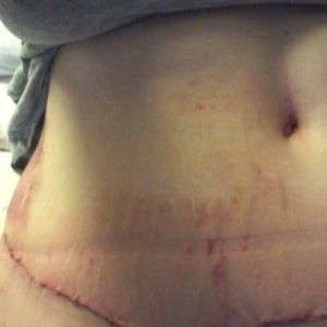 Đau, sưng nề, co rút cơ bụng sau 2 tuần từ khi làm tạo hình thành bụng. Có bình thường không?