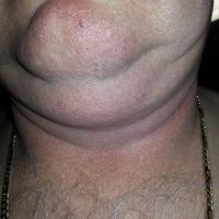 Tôi cần thu gọn 30kg trên cơ thể, hút mỡ có giúp tôi không? Tôi cần thu gọn 30kg trên cơ thể, hút mỡ có giúp tôi không?