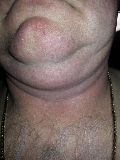 Tôi cần thu gọn 30kg trên cơ thể, hút mỡ có giúp tôi không? Tôi cần thu gọn 30kg trên cơ thể, hút mỡ có giúp tôi không?