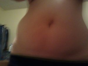 Tôi thấy da mình không bị chảy xệ, tôi có hợp làm hút mỡ (bụng, lườn, lưng) không?