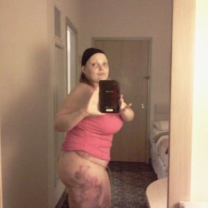 Đau, sưng nề, co rút cơ bụng sau 2 tuần từ khi làm tạo hình thành bụng. Có bình thường không?