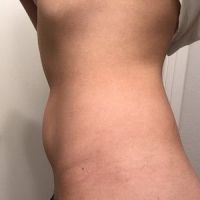 Tôi khá gầy thì nên chọn hút mỡ hay tiếp tục làm đông hủy mỡ CoolSculpting? Tôi khá gầy thì nên chọn hút mỡ hay tiếp tục làm đông hủy mỡ CoolSculpting?