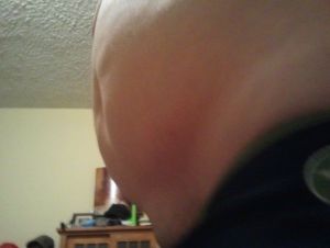 Tôi thấy da mình không bị chảy xệ, tôi có hợp làm hút mỡ (bụng, lườn, lưng) không?