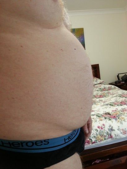 Tôi cần thu gọn 30kg trên cơ thể, hút mỡ có giúp tôi không? Tôi cần thu gọn 30kg trên cơ thể, hút mỡ có giúp tôi không?