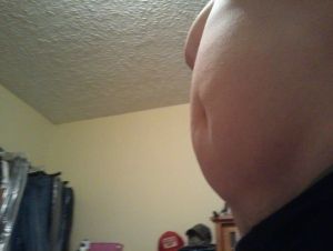 Tôi thấy da mình không bị chảy xệ, tôi có hợp làm hút mỡ (bụng, lườn, lưng) không?