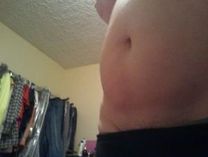 Tôi thấy da mình không bị chảy xệ, tôi có hợp làm hút mỡ (bụng, lườn, lưng) không?