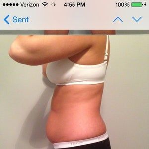 Tôi cao 1m67, nặng 74,8kg, 22 tuổi - có phù hợp làm hút mỡ không?