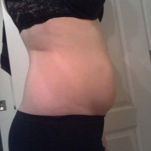 Cao 1m7, nặng 72 kg, tôi nên làm thủ thuật nào là tốt nhất? Tôi muốn hút mỡ ở bụng và hông?