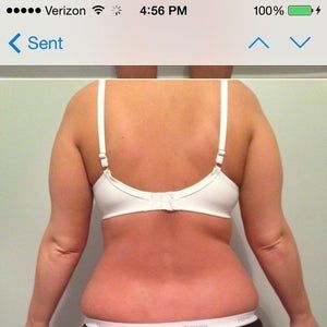 Tôi cao 1m67, nặng 74,8kg, 22 tuổi - có phù hợp làm hút mỡ không?