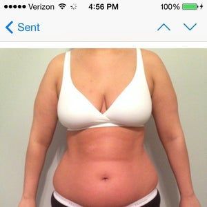 Tôi cao 1m67, nặng 74,8kg, 22 tuổi - có phù hợp làm hút mỡ không?