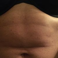 Có thủ thuật nào xóa được vết hằn sâu ở bụng tôi không?