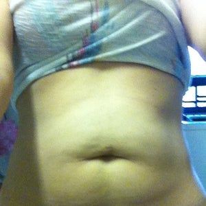 29 tuổi, không bị rạn da: Tôi có phù hợp làm hút mỡ bụng và cấy mỡ tự thân ở mông không?