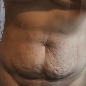 Tôi nặng 70kg, đang giảm cân, đã có hai con và 33 tuổi, tôi có thể hút mỡ thay vì làm tạo hình thành bụng không?