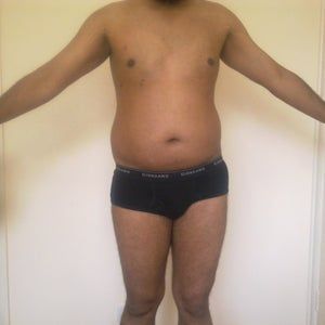 Liệu da của tôi có bị chảy xệ/lỏng lẻo sau hút mỡ không?