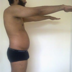 Liệu da của tôi có bị chảy xệ/lỏng lẻo sau hút mỡ không?